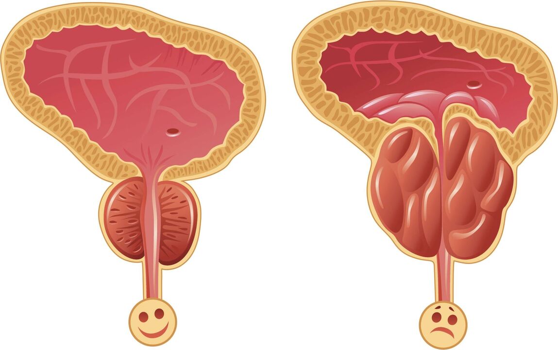 ragioni per lo sviluppo della prostatite