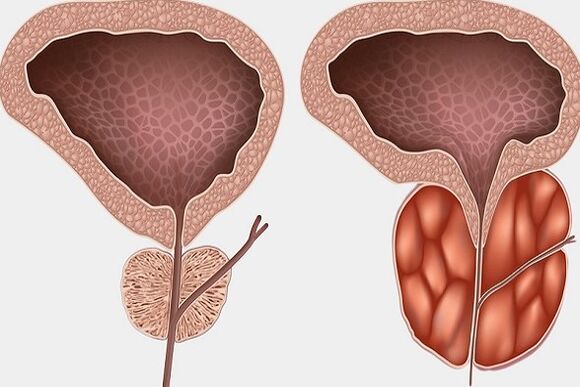 Infiammazione della prostata