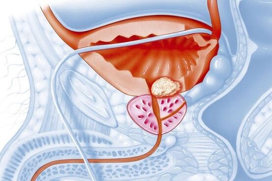 Processo infiammatorio nella prostata