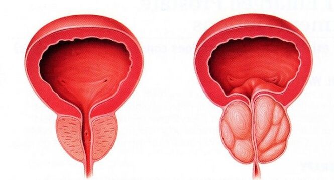 prostata sana e infiammata con prostatite cronica