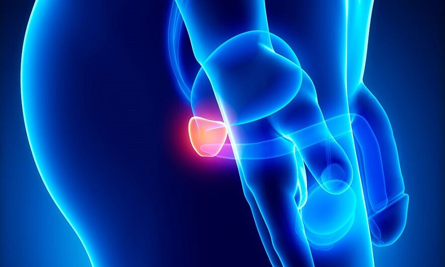 Infiammazione della prostata con prostatite