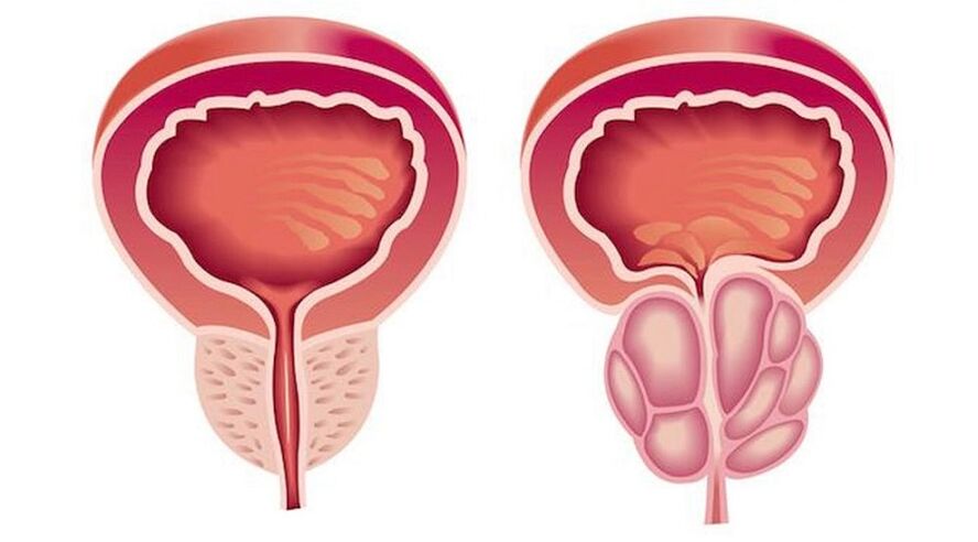 Prostata sana e infiammata con prostatite