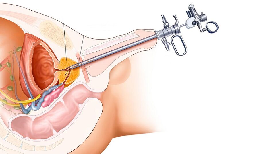 Trattamento chirurgico della prostatite